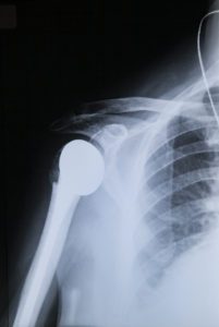 woman shoulder bone scan with a prosthesis