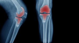 X-ray image, total knee artroplasty in blue