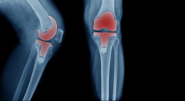 X-ray image, total knee artroplasty in blue