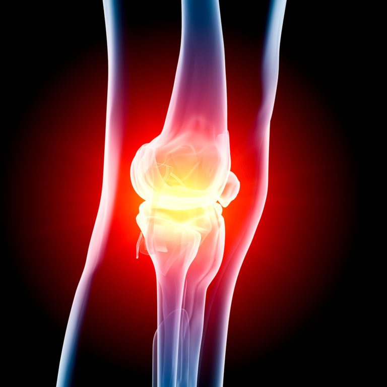 Knee Arthritis