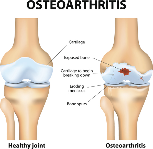 Knee Osteoarthritis
