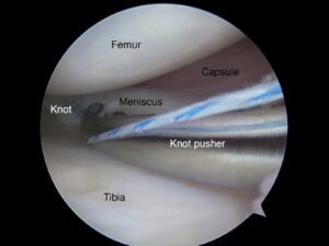 Graphical image of Meniscal surgery