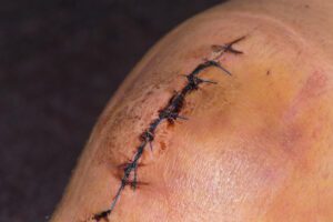 Male knee after meniscal surgery