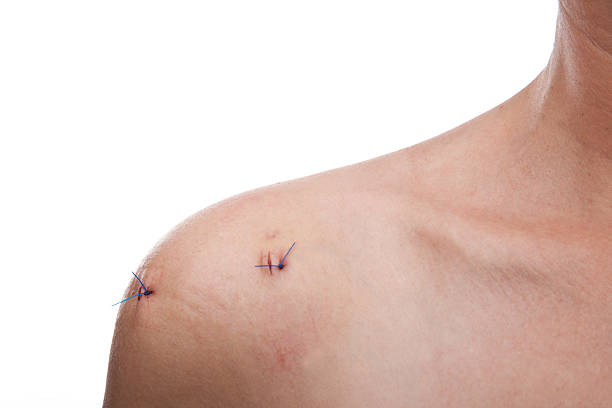 shoulder with stiches after shoulder surgery