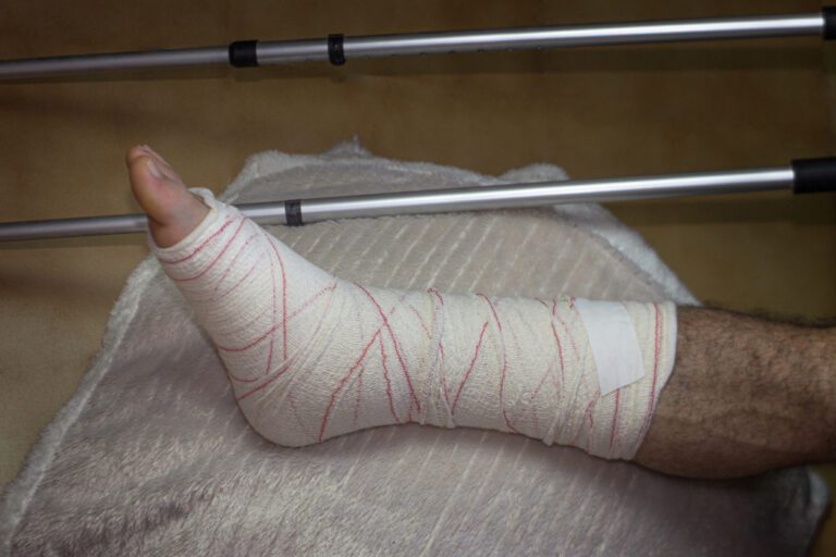 Selective shot of broken leg in a cast and crutches