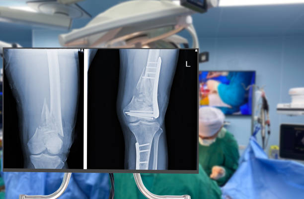 x-ray of leg and knee. Blurry Traumatology orthopedic surgery hospital emergency operating room for the leg broken operation. Medical health and Education concept.