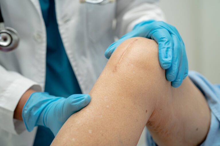 patient scars surgical total knee replacement surgery