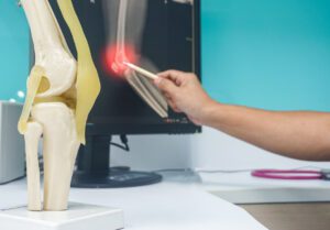 knee surgeon pointing to x-ray knee on monitor LCD and model knee on the white table