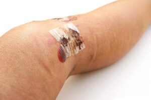 Knee After ACL Reconstruction and Meniscus Repair.