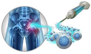 Hip Stem Cell Therapy illustration is an example of regenerative orthopedic treatment.