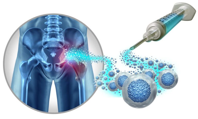 Hip Stem Cell Therapy illustration is an example of regenerative orthopedic treatment.