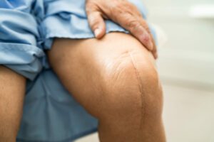 An obese elderly woman patient shows her surgical scars from total knee joint replacement surgery while in bed at the hospital.